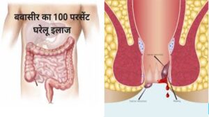 बवासीर के देसी इलाज: घरेलू उपाय से पाएं आराम