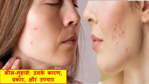 कील-मुंहासे: घरेलू नुस्खे और चिकित्सा उपाय